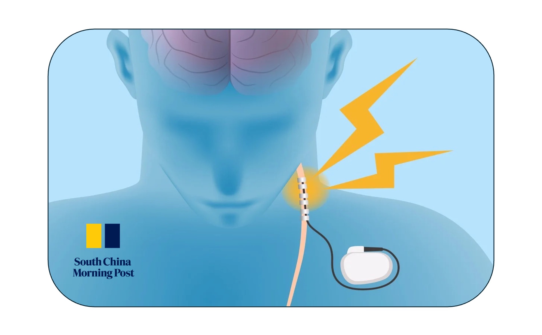 What is Vagus Nerve Stimulation